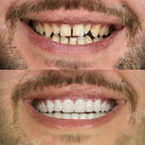 before-after photo installation-of-a-veneer