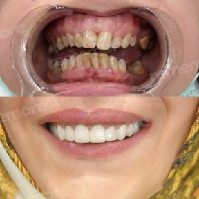 before-after photo installation-of-a-veneer