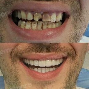 before-after photo installation-of-a-veneer