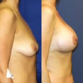 before-after photo breast-implants-with-breast-lift