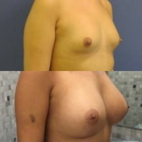 before-after photo breast-implants-with-breast-lift
