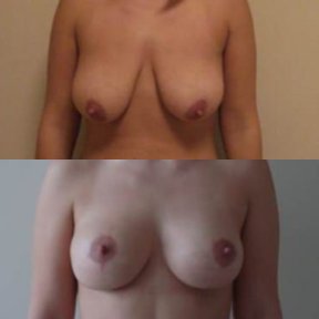 before-after photo breast-implants-with-breast-lift