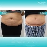 Before and after liposuction at Wansiri Hospital, visible abdominal contour improvement result