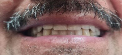 before-after photo denture