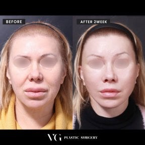 Before and after facelift results at VG Plastic Surgery, visible facial rejuvenation after 2 weeks