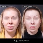 Before and after facelift results at VG Plastic Surgery, visible facial rejuvenation after 2 weeks