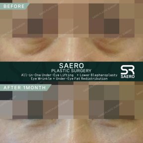 Resultados de lifting de ojeras y blefaroplastia inferior en SAERO Plastic Surgery tras 1 mes