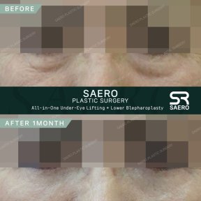 Resultados de lifting bajo los ojos y blefaroplastia inferior en SAERO tras 1 mes