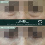 Resultados de lifting bajo los ojos y blefaroplastia inferior en SAERO tras 1 mes