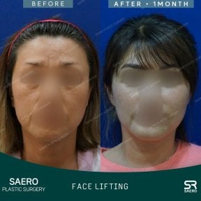 Resultados de lifting facial antes y después en SAERO Plastic Surgery, rejuvenecimiento visible