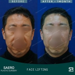 Resultados de lifting facial antes y después en SAERO Plastic Surgery, rejuvenecimiento visible