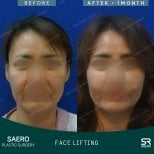 Resultados de lifting facial antes y después en SAERO Plastic Surgery, rejuvenecimiento visible