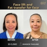 Facelift and facial fat transfer before and after results at ID Clinic Bangkok, rejuvenated look