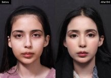 Before and after rhinoplasty result at VG Plastic Surgery, nose reshaping with natural look