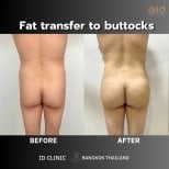 До и после липофилинга ягодиц в ID Clinic Bangkok, улучшенный контур тела