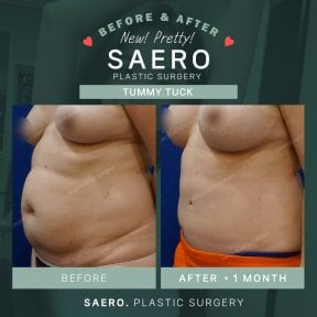 Before and after tummy tuck results at SAERO Plastic Surgery – visible abdominal contouring