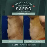 Before and after tummy tuck results at SAERO Plastic Surgery – flatter abdomen after 1 month