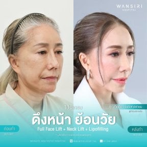 Before and after facelift, neck lift, and lipofilling results at Wansiri Hospital