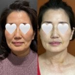 Before and after nonsurgical facelift results at Lalian Cheongdam Clinic, facial rejuvenation