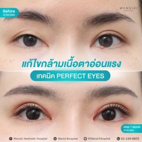 Before and after droopy eyelid surgery results at Wansiri Hospital, improved eye appearance