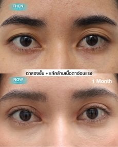 Before and after droopy eyelid surgery results at Wansiri Hospital, improved eyelid appearance
