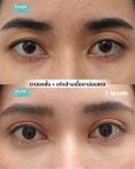Before and after droopy eyelid surgery results at Wansiri Hospital, improved eyelid appearance