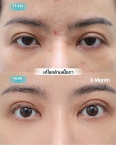 Before and after droopy eyelid surgery results at Wansiri Hospital, improved eyelid appearance