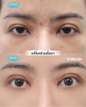 Before and after droopy eyelid surgery results at Wansiri Hospital, improved eyelid appearance