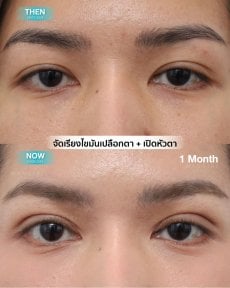 Before and after droopy eyelid surgery results at Wansiri Hospital, improved eye appearance