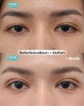 Before and after droopy eyelid surgery results at Wansiri Hospital, improved eye appearance