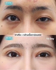 Before and after droopy eyelid surgery results at Wansiri Hospital, improved eyelid appearance