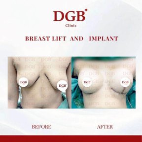 Before and after breast lift with implants at DGB Clinic, visible contour improvement result