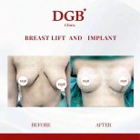 Before and after breast lift with implants at DGB Clinic, visible contour improvement result