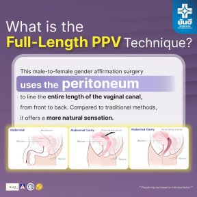 Full-length PPV male to female surgery at Yanhee International Hospital, peritoneum technique