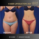 Before and after VASER abdominal liposuction results at ID Clinic Bangkok, body contouring