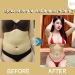 Before and after abdominal liposuction results at ID Clinic Bangkok, enhanced body contour