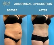 Before and after abdominal liposuction results at ID Clinic Bangkok, visible body contouring