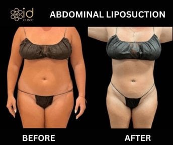 Before and after abdominal liposuction results at ID Clinic Bangkok, visible body contouring