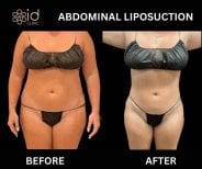 Before and after abdominal liposuction results at ID Clinic Bangkok, visible body contouring