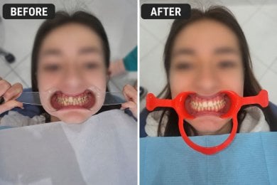 Before and after braces results at Unident Clinic – improved teeth alignment and smile