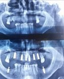 Результат до і після імплантації All-on-6 у Dential Dental Clinic, покращення верхньої щелепи