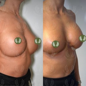 Vorher-nachher-Ergebnis Bruststraffung bei Dr. Safa Manav Clinic, verbesserte Kontur