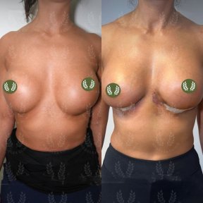 Vorher-nachher-Ergebnis Bruststraffung bei Dr. Safa Manav Clinic, verbesserte Kontur