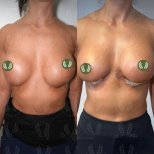Vorher-nachher-Ergebnis Bruststraffung bei Dr. Safa Manav Clinic, verbesserte Kontur