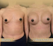 Vorher-nachher-Ergebnis Bruststraffung bei Dr. Safa Manav Clinic, sichtbare Veränderung