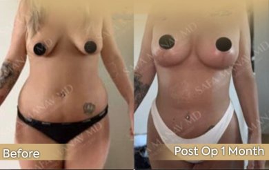 Vorher-nachher-Ergebnis Bruststraffung bei Dr. Safa Manav Clinic, sichtbare Straffung
