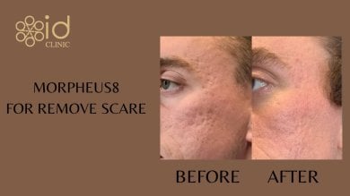 before-after photo neck-lift