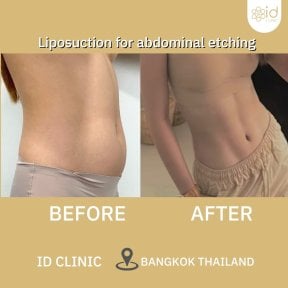 before-after photo vaser-liposakcia