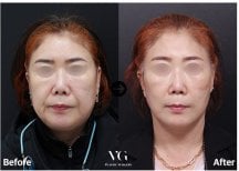Before and after deep plane facelift results at VG Plastic Surgery, visible facial rejuvenation