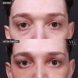 Résultats de blépharoplastie avant et après chez VG Plastic Surgery, paupières améliorées